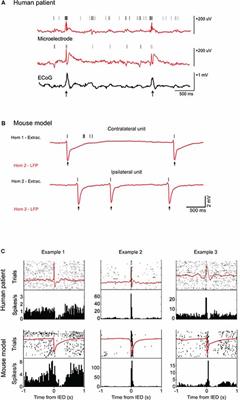 Transient Cognitive Impairment in Epilepsy